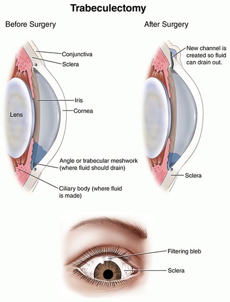 Glaucoma Treatment Photo